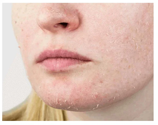 Sécheresse cutanée sur le corps : peau du bas du visage jusqu’au nez extrêmement sèche et écailleuse